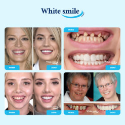 Alternative view of WHITESMILE™ – Faccetta Dentale Cosmetica Regolabile